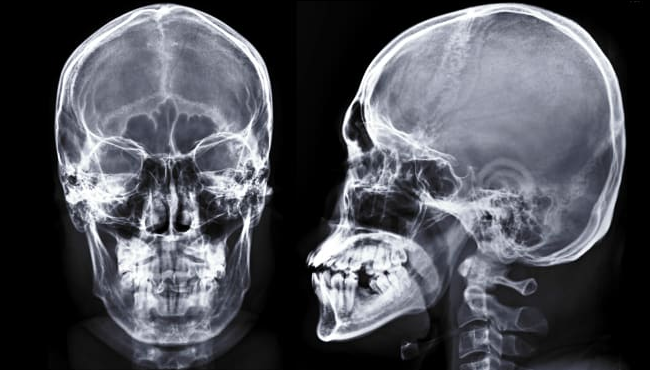 New MIT Skull Study Analysis Calls For 70% Chance Of Recession In Next Six Months