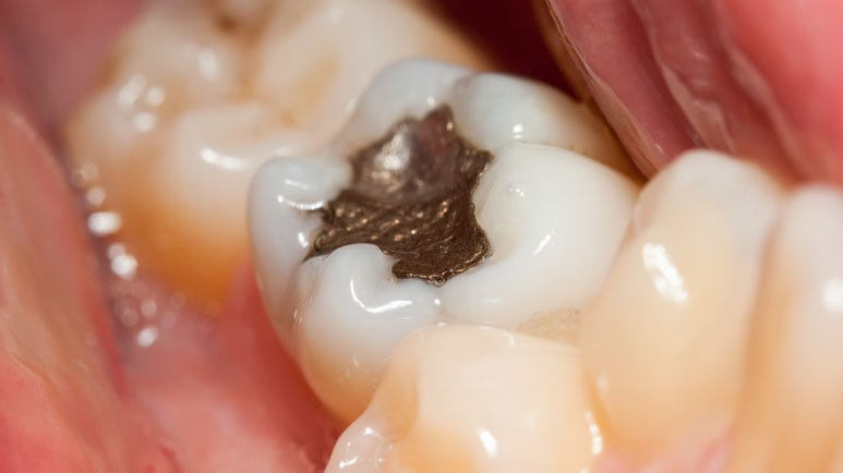 Movement to Stop Mercury in Dentistry Gains Momentum