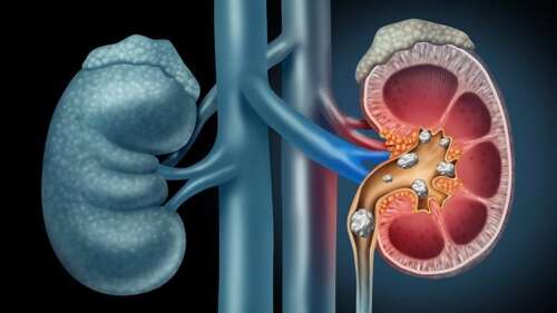 Antibiotics Linked to Increased Risk of Kidney Stones