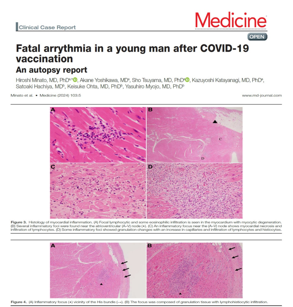 Ventricular Tachycardia Cardiac Arrest after mRNA COVID-19 Vaccination