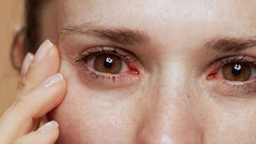 Natural Remedies for the Prevention of Dry Eyes