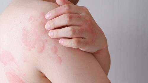 Is Histamine to Blame for Your Headache, Hives and Heartburn?