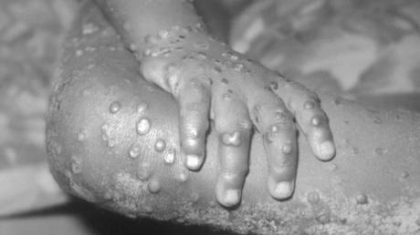Moscow comments on global monkeypox outbreak