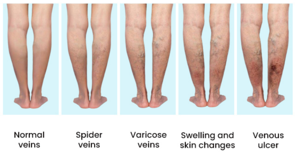 Role of Bromelain and Vitamin C in Chronic Venous Disease