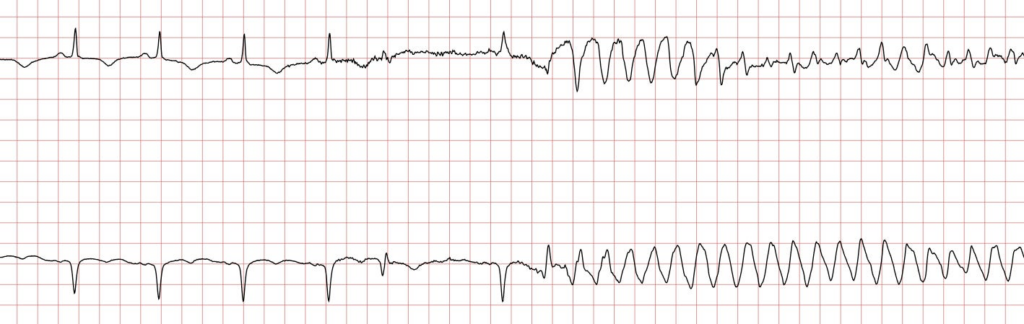 Ventricular Arrhythmias after COVID-19 Vaccination