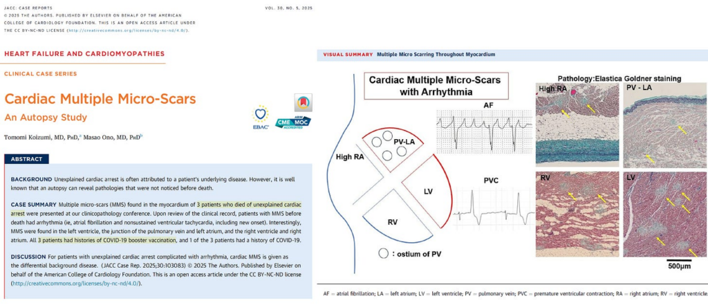 Cardiac Micro-Scars Possible Manifestation of COVID-19 Vaccine Subclinical Myocarditis