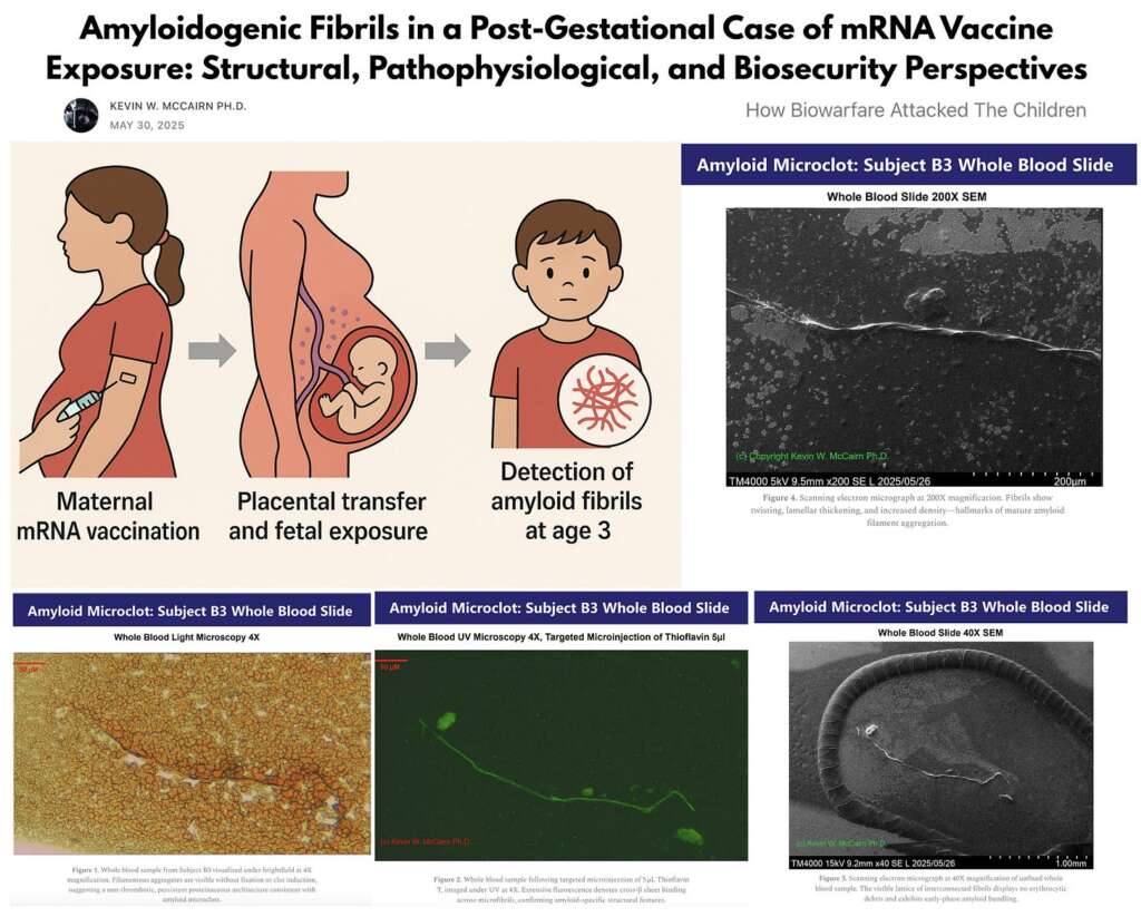 BREAKING: Prion-Like Amyloid Fibrils Found in 3-Year-Old Born Lifeless After In-Utero Pfizer mRNA Injection Exposure