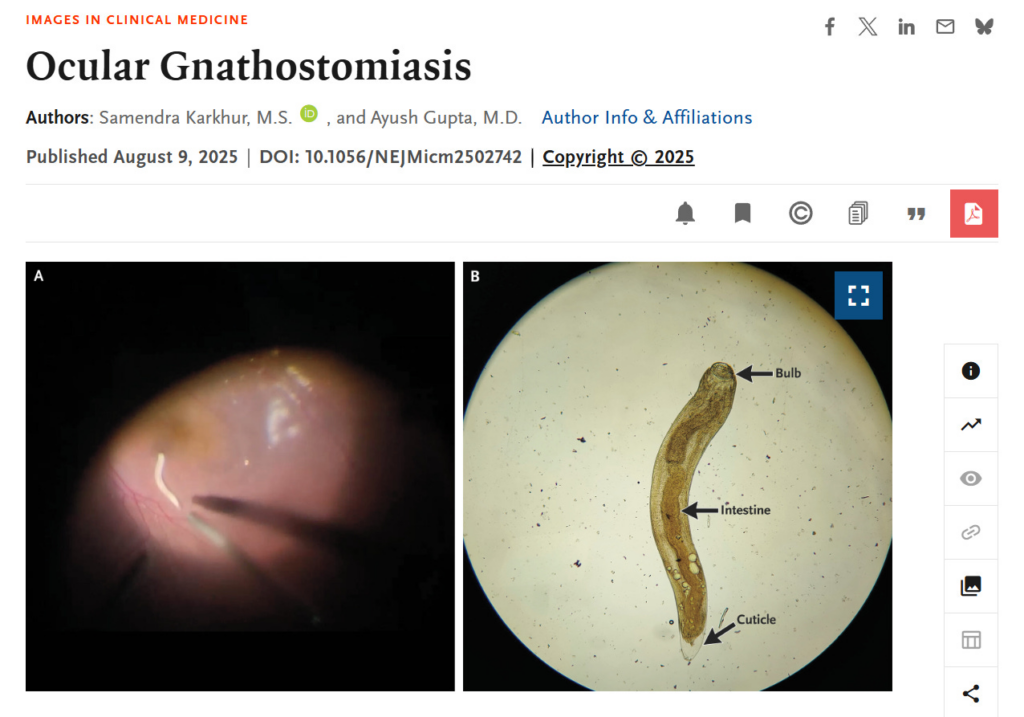 Ocular Gnathostomiasis