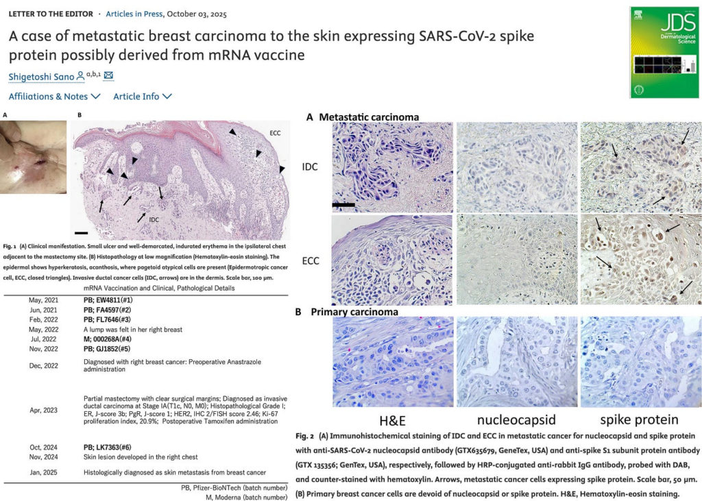 BREAKING: Metastatic Breast Cancer Tumor Found Expressing Spike Protein After Six mRNA Shots