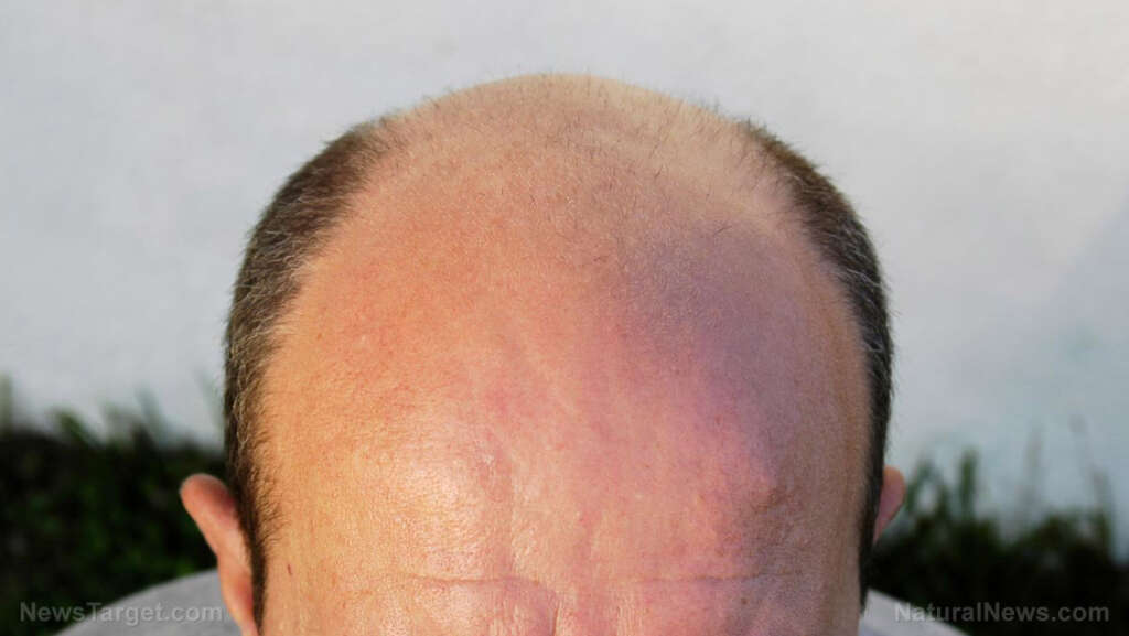 A sweet solution to baldness? Stevia compound supercharges decades-old hair loss treatment