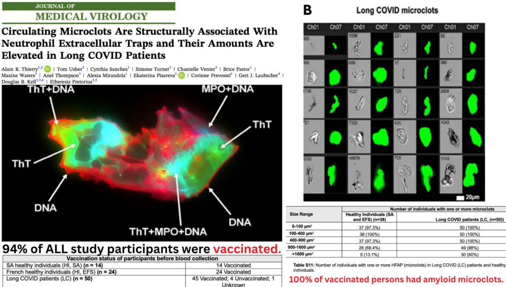 BREAKING STUDY: Anomalous Amyloid Microclots Found in 100% of the COVID-19 Vaccinated