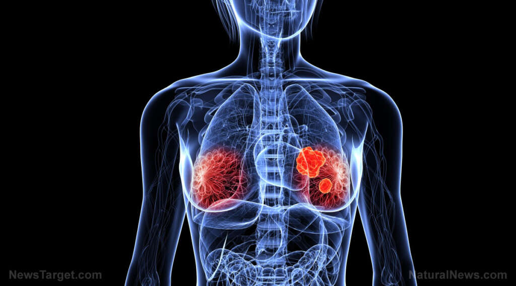 Existing NHS drug shows promise in preventing breast cancer in high-risk women